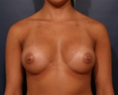 Feel Beautiful - Breast Augmentation Case 46 - After Photo